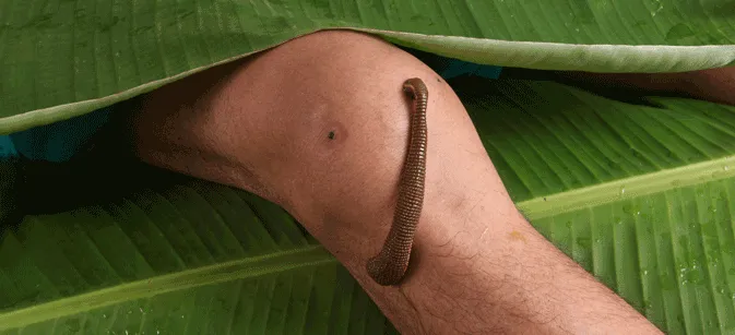 Leech Therapy
